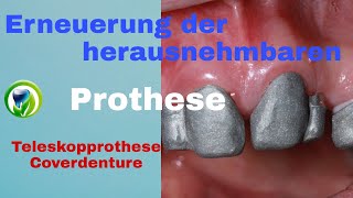 Erneuerung der herausnehmbaren Teilprothese  Teleskopprothese  Coverdenture [upl. by Ankeny]