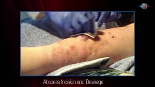 WCW Abscess Incision and Drainage [upl. by Ramej]