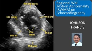 Regional Wall Motion Abnormality RWMA on Echocardiography [upl. by Hernando732]