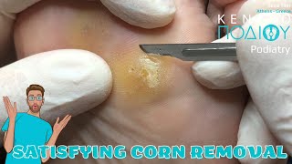 Corn Removal feet κεντροποδιου foot podologos podiatrist corn footcare podiatry callus [upl. by Bender]