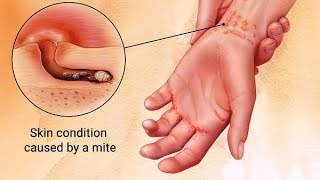 Causes Symptoms and Treatment of Scabies [upl. by Thorvald]