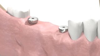 SIC invent Dental Implant  Prosthetic Animation BridgeWork Open Tray Technique [upl. by Ynaffit]