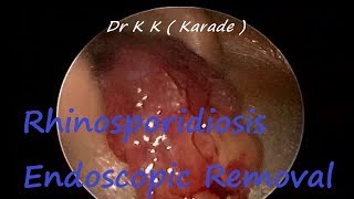 Rhinosporidiosis  Nasopharyngeal Part Endoscopic Removal [upl. by Edla]