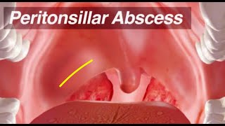 Peritonsillar Abscess  Identification and Treatment [upl. by Akenehs]