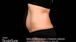 SculpSure Before amp After Pictures  SculpSure Palm Beach [upl. by Ellesirg]