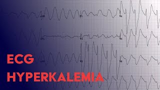 Hyperkalemia EKG Findings  ECG Interpretation [upl. by Briggs]