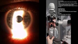 Slit Lamp Sclerotic scatter [upl. by Olotrab]