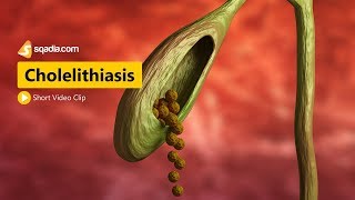 Cholelithiasis  I  Gastroenterology Medicine Animation  VLearning  sqadiacom [upl. by Verras]