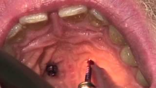 OrthoEasy  Removal of pin palatinal in maxilla [upl. by Alekal217]