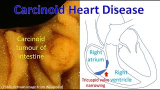 Carcinoid Heart Disease [upl. by Nahshun]