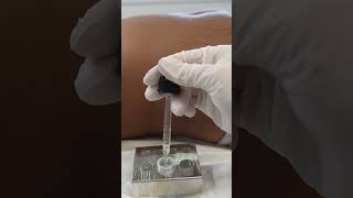 Stretch Marks Inkless Removal Boleyn Treatment Los Angeles 🌍 shorts [upl. by Ainerol]