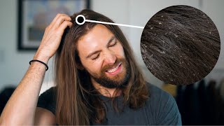 What Do Flakes In Your Hair REALLY Mean Dandruff From Itchy Dry Scalp Vs Seborrheic Dermatitis [upl. by Jack279]