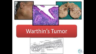 Warthins tumor [upl. by Eejan]