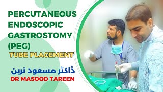 Percutaneous endoscopic gastrostomy PEG tube placement  Dr Masood Tareen [upl. by Aerdnahs]