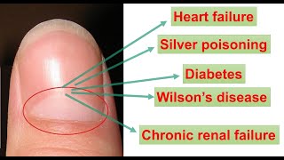 BIOLOGY BEHIND HALFMOON SHAPE ON OUR FINGERNAILS WHITEBLACKYELLOW SPOT ON NAIL LUNULAE [upl. by Thoma]