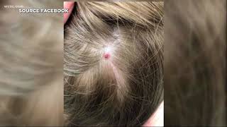 Tick bite temporarily paralyzes 5yearold [upl. by Aicatan]