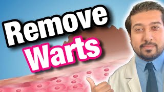 Wart Removal 101  How to Get Rid of Warts [upl. by Hoeg]