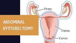 HYSTERECTOMY  The White Army [upl. by Evanthe538]