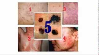 Common Skin Diseases and Disorders [upl. by Grider]