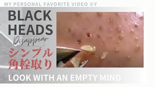 This is a simple video of removing blackheads from the nose using tweezers  3 hours シンプル角栓除去長時間動画 [upl. by Katrina466]