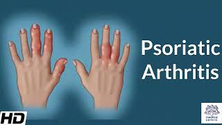 Psoriatic Arthritis Causes Signs and Symptoms Diagnosis and Treatment [upl. by Lener191]