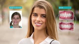 Carriere patients Video showing before and after braces [upl. by Rafaelita572]