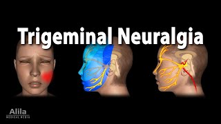 Trigeminal Neuralgia Tic Douloureux Animation [upl. by Akeihsat]