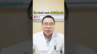 How to treat black neck of ichthyosis ichthyosis ichthyosisvulgaris dryskin dermatologist [upl. by Lodi]