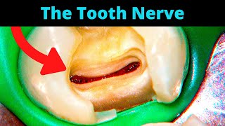 Tooth Cavity  Partial Pulpotomy Procedure Healed Without a Root Canal  Dr Ricucci [upl. by Neroled]