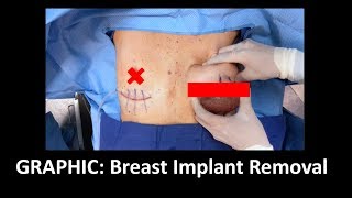 GRAPHIC En Bloc Capsulectomy Implant Removal w Explanation [upl. by Olds]