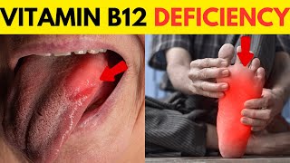 Vitamin B12 Deficiency Symptoms  B12 Deficiency  Vitamin B12  All You Need to Know [upl. by Okiman361]