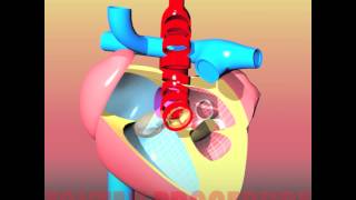 Congenital heart defects III HLHS  Hypoplastic Left Heart Syndrome [upl. by Mcneil]