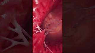 Animation of the mitral valve and left ventricle anatomy meded [upl. by Raffaj]