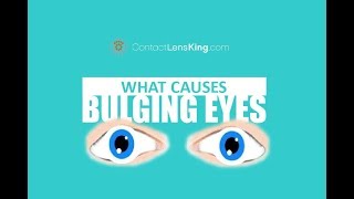 BULGING EYES  Causes Symptoms and Treatment  Exophthalmos Exopthalmia Exorbitsm and Proptosis [upl. by Okimat]