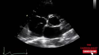 Eustachian Valve [upl. by Rosalind]