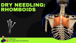 Dry Needling Rhomboids [upl. by Eedyaj]