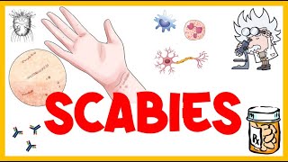 Scabies  Life Cycle Pathogenesis Types Signs amp Symptoms Risk Factors Diagnosis amp Treatment [upl. by Rika]