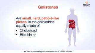 Gallstones  Cholelithiasis Symptoms Causes Diagnosis and Treatment [upl. by Laktasic74]