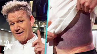 Gordon Ramsay Reveals MASSIVE Bruise After Bike Accident [upl. by Ashwell235]