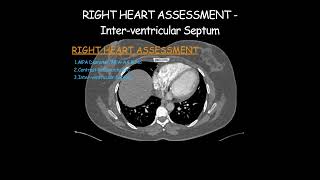 Right Heart Assessment  Interventricular Septum radiologist radiology technique heart [upl. by Aneliram]