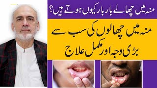 Mouth Blisters CausesSymptoms And Treatment  Muh K Chalon Ka Ilaj In UrduHindi [upl. by Brag]