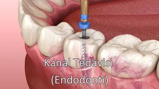 Kanal Tedavisi  Endodonti [upl. by Rodrick114]