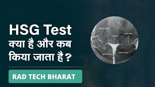 HSG Test क्या है और कब किया जाता है  HSG Test kya hota hai  HSG Test kyu kiya jata hai [upl. by Ydroj171]