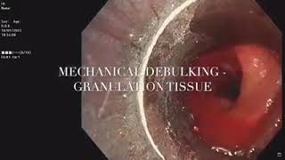 Tracheal Granulation tissue  Rigid bronchoscopy  Cryorecanalisation [upl. by Cad]