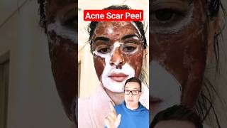 DRAMATIC CHEMICAL PEEL  Phenol Peel For Acne Scars shorts [upl. by Janeta]