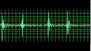 Prosthetic Mitral Valve Closing Click slow [upl. by Hsreh893]