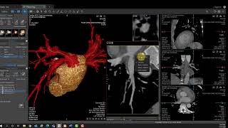 Vitrea Demonstrations  EP Planning [upl. by Rebekkah]