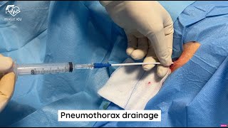 Pneumothorax drainage [upl. by Ahtram]