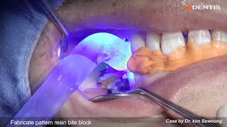 DENTIS Implant Analog method of taking bite impression with Multi Use Coping [upl. by Sofie]