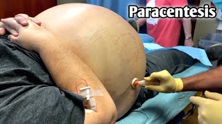 شاهد كيف يتم سحب السوائل من البطن الأستسقاء  Remove abdominal fluid ascites  Paracentesis [upl. by Hege]